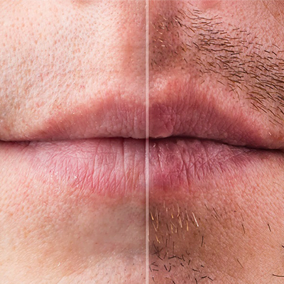 beard-transplant