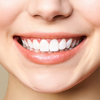 dental-veneers
