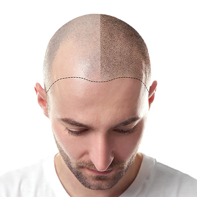 hair-transplant